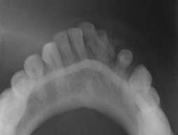 anterior region Discussion The peripheral odontogenic fibroma is a rare, benign, focal overgrowth of