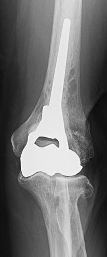 SUBSIDENCE & OA HEMIARTHROPLASTY FOR Insertion of humeral