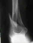 Lec: 3 Fractures and dislocations around elbow in adult These include fractures of distal humerus, fracture of the capitulum, fracture of the radial head,