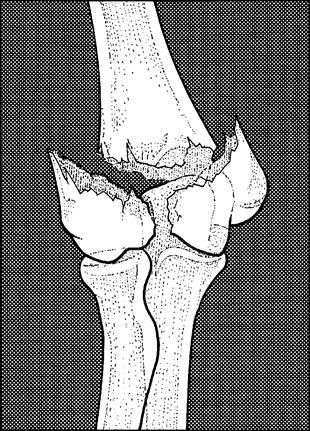 Fractures of distal humerus This is usually occurring as a high energy trauma in the young patient, these injuries are divided into 3 types according to AO