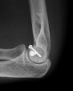 Mechanism of injury; it is caused by fall on hand with the elbow extended & forearm pronated; the radial head will impact against the capitulum causing splitting or