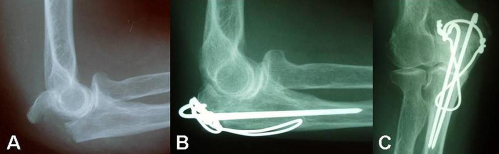 Complications; (1) elbow stiffness (2) nonunion (3) osteoarthritis of the elbow this can occur as a late complication.