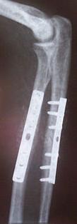 In adults: closed reduction is difficult &liable for redisplacement in the cast; so ORIF is