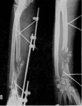 Early: 1- Nerve injury: by the # is rare; by the surgeon could be like the posterior