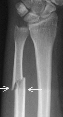 Fracture of a single forearm bone These are uncommon injuries,