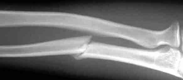 is usually called nightstick fracture.
