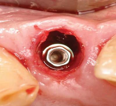 Bone and Crescent Shaped Free Gingival Grafting for Anterior Immediate Implant Placement: Technique and Case Report Han et al Thomas Han, DDS, MS 1 2 Abstract Immediate implant placement in a single