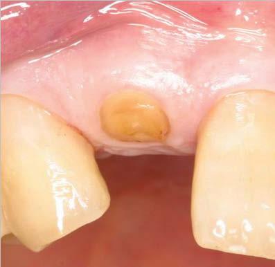 Figure 1: Gingival fracture of the maxillary right lateral incisor. Figure 1a: Probing of extraction socket.