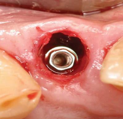 Figure 3: Extraction Socket with implant immediately placed in palatal position. Figure 4: Bone graft material packed in the gap between the implant and facial bone.