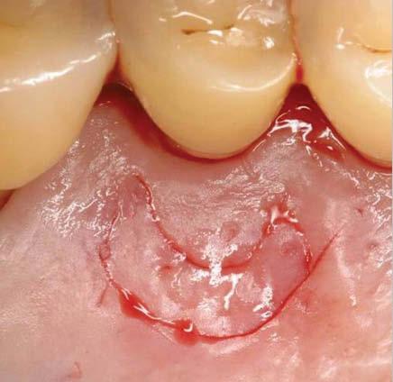 Figure 5: Crescent shaped free gingival graft is harvested from the ipsilateral palate. Figure 6: Collacote is placed into the donor site and sutured.