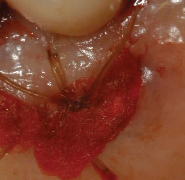 margin of the canine or premolars. The crescent shape follows the palatal gingival outline of the adjacent dentition (figure 5). This will ensure the proper fitting of the graft in the recipient site.