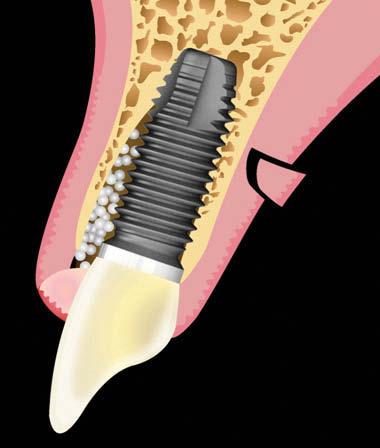 Since the bucco-lingual thickness of the graft is slightly thicker than the recipient space, it may have a tendency to displace.