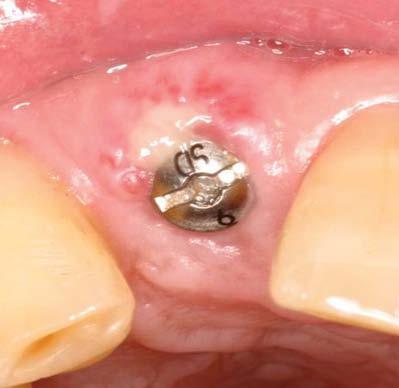 Figure 9: Free gingival graft secured with three sutures. Figure 10: 1 week postsurgical visit. thickness level.