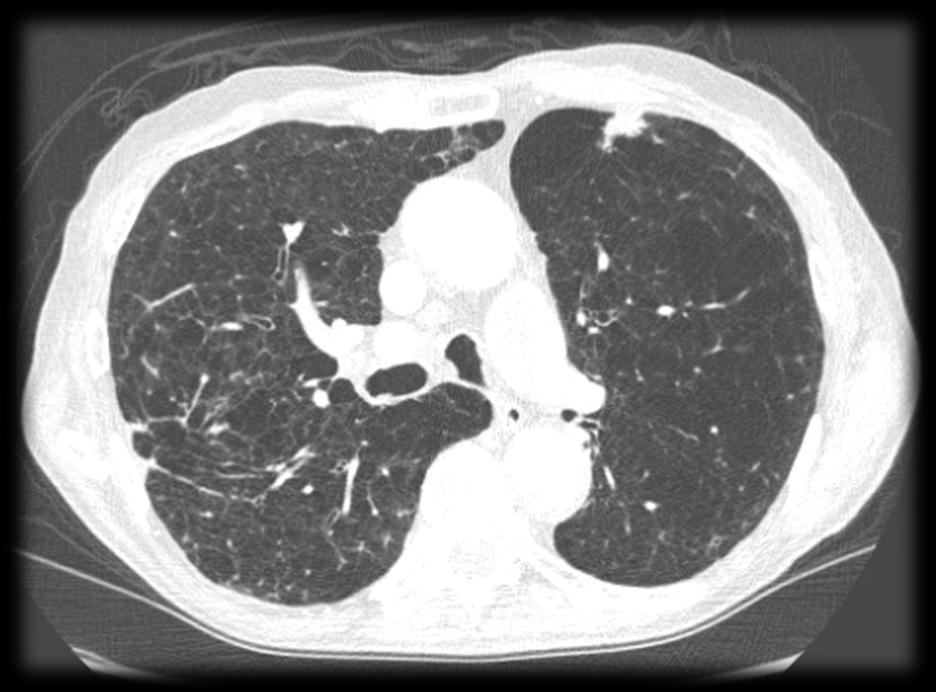 lung cancer 2 Years