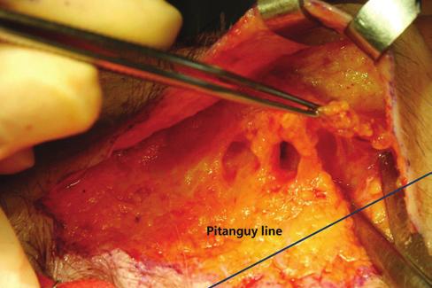 30 Aesthetic Surgery Journal 34(1) Figure 3. The medial orbicularis oculi muscle is elevated to avoid damaging the Pitanguy line and preventing temporal nerve branch injury.