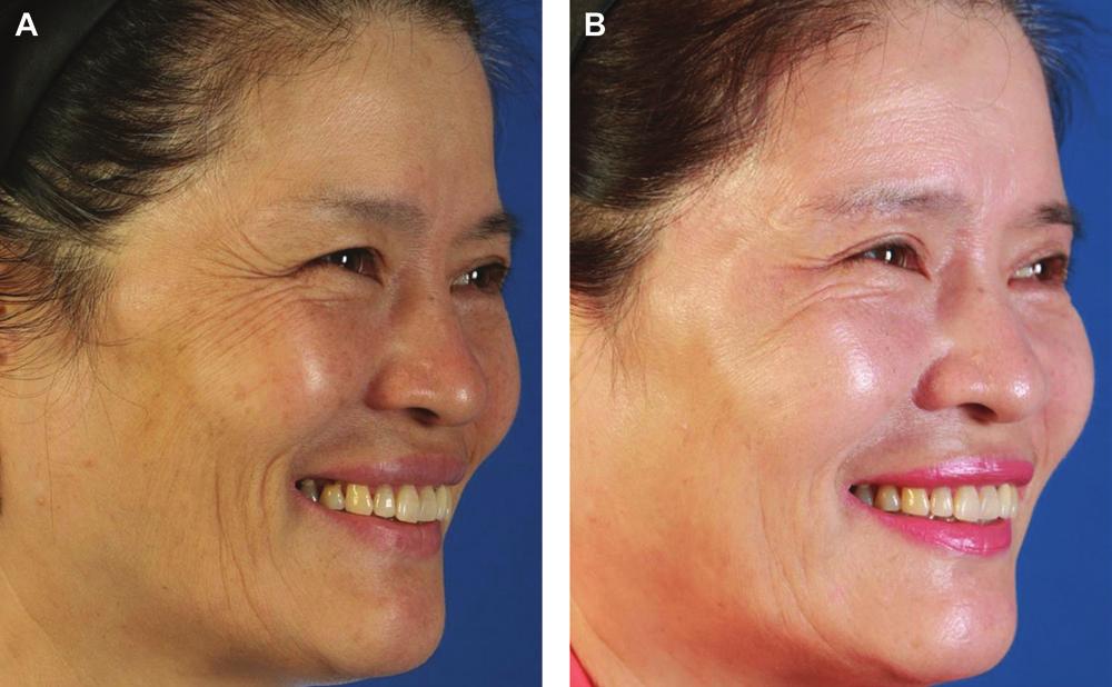 The patient also underwent a concurrent facelift and upper and lower blepharoplasty. Figure 7.