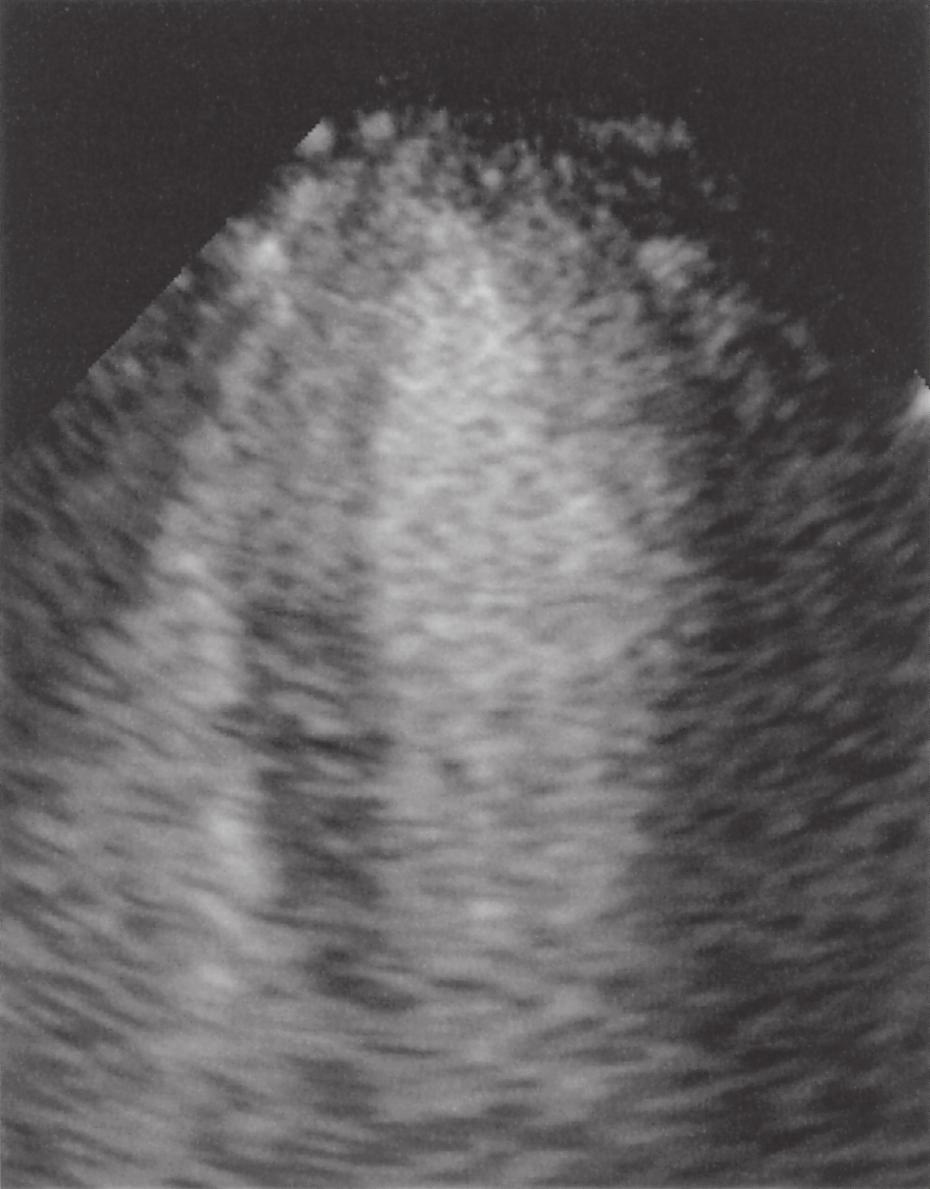 164 Ito Acta Med. Okayama Vol. 63, No. 4 Normal case Anterior MI Fig. 3 Myocardial contrast echocardiograms in a normal case and in a patient with anterior myocardial infarction.