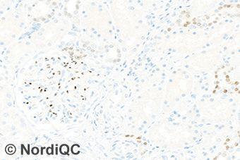 Virtually all laboratories were able to demonstrate GATA3 in high-level antigen expressing cells, such as neoplastic cells of the breast ductal carcinoma and epithelial cells of the renal collecting