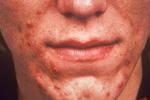 Acne Vulgaris most common skin disorder sebum and epithelial cells clog glands produces whiteheads and blackheads (comedones) anaerobic bacteria trigger