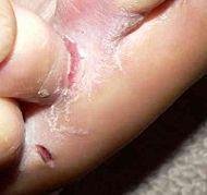 Athlete s Foot Fungual infection usually in the skin of the