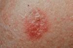 type of skin cancer Melanomas arise from melanocytes