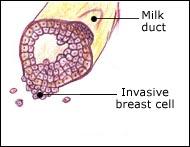 Invasive breast cancer Abnormal cancer cells spread outside the milk ducts or the lobules. These abnormal cells first spread to the surrounding breast tissue.