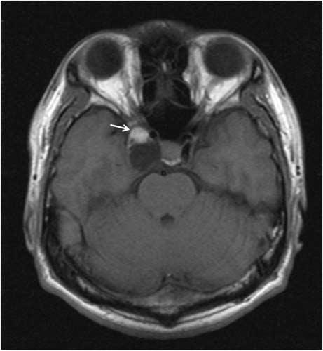 The precontrast CT scan demonstrated a well-defined contour-bulging oval shaped hypoattenuated