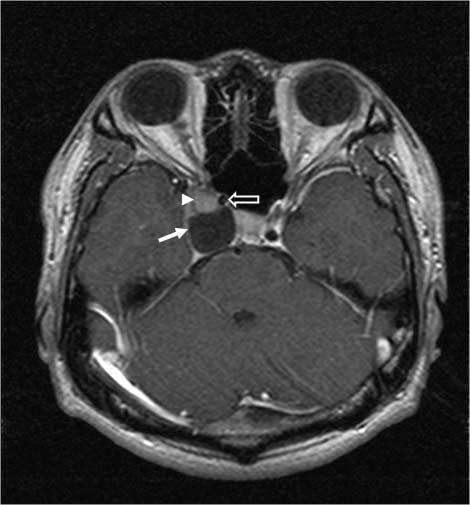 demonstrable enhancement of the mass in the right cavernous sinus on the postcontrast