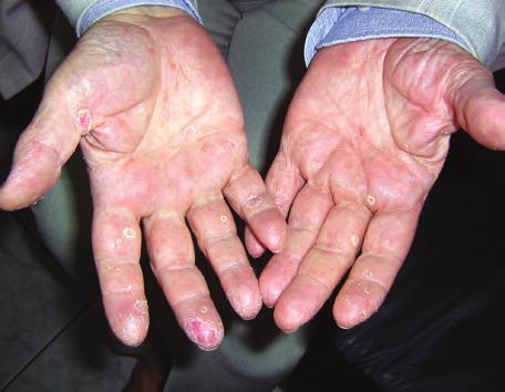 Figura 1. Leziuni eritemato-scuamoase, descuamative, localizate palmar bilateral ºi pe feþele laterale ale degetelor ºi regiunile periunghiale de la mâini. Figure 1.
