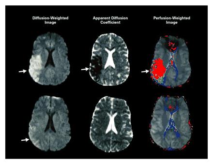 Vertebro-Basilar Insufficiency - Brainstem & Cerebellar signs Diplopia Dysphagia Dysarthria Dizziness Cranial nerve palsies
