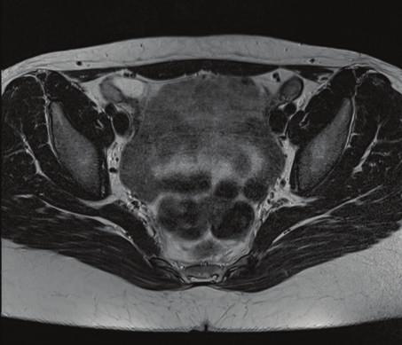 Case Reports in Radiology 3 (a) (b) (c) Figure3:22-year-oldgirl/femaleaffectedbyCAIS.