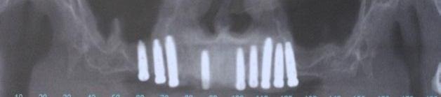 56 implants were placed palatally anchored in the palatal bone curvature and 140 were placed