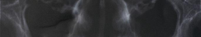 3 a: Panoramic radiograph of bilaterally edentulous patient prior to implant placement. Fig.