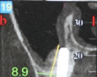Fig. 4 a,b,c: Preoperative and postoperative cross-sectional CT scans showing the implant position in the palatal wall of the maxilla and the presence of dense bone around and above the implants.