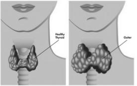 THYROID DISEASE THYROID DISORDERS Often traced to on of the following: Too much thyroid hormone Too little thyroid hormone Abnormal growth of thyroid Goiters nodules itis Nodules within the