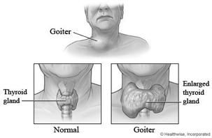 TREATMENT FOR GOITERS Depends on cause of goiter Asymptomatic à no treatment Hashimoto s à treat with thyroid hormone Grave s à treat with radioactive iodine If very large or therapy fails à surgical