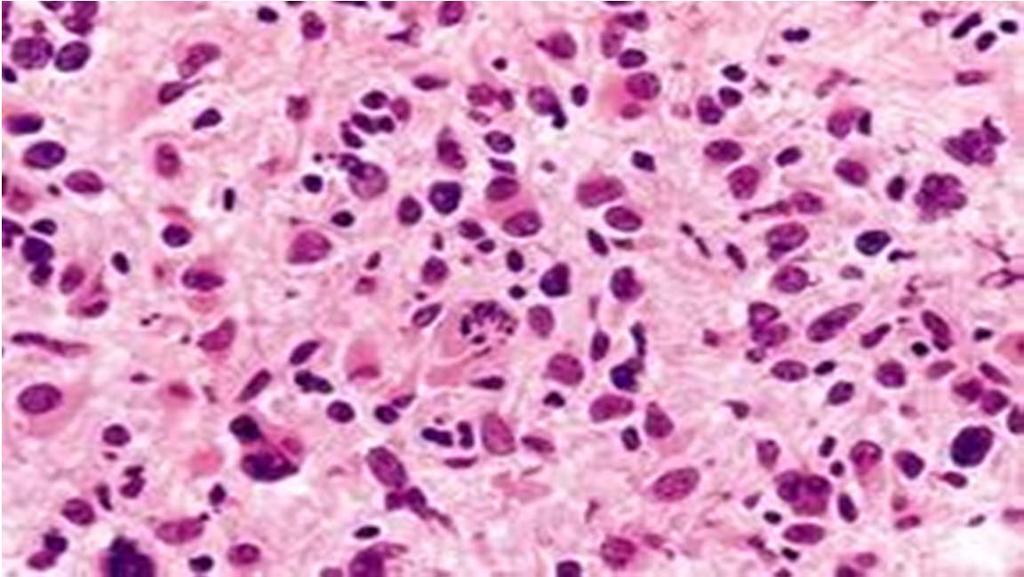 density nuclear pleomorphism mitoses are