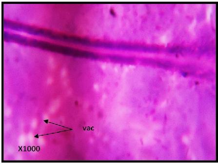 Mucosa degeneration vacuolation lining epithelial cells was a constant Mukherjee, De and Sardar 18 feature (Fig. 8).