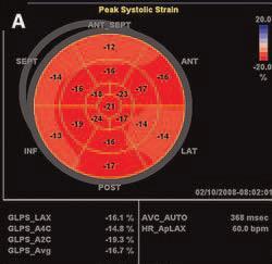 maps of peak longitudinal strain in A)
