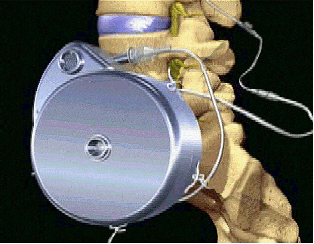 Implantable Pain