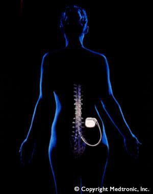 Neurostimulation A pain treatment that delivers low voltage electrical stimulation to the spinal cord to inhibit or block the sensation of pain.