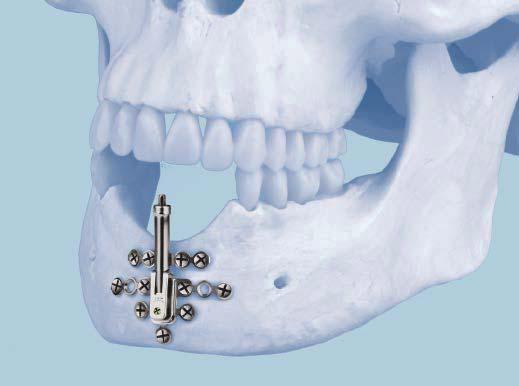 fiber construct for consolidation phase Made of lightweight titanium alloy Single Vector Distractor Internal distraction of mandibular ramus Detachable footplates for less invasive removal