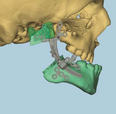 Synthes PROPLAN CMF planning service allows: Live interactive planning session with a knowledgeable support team Surgeons to make critical clinical decisions preoperatively 2D and 3D visualization of