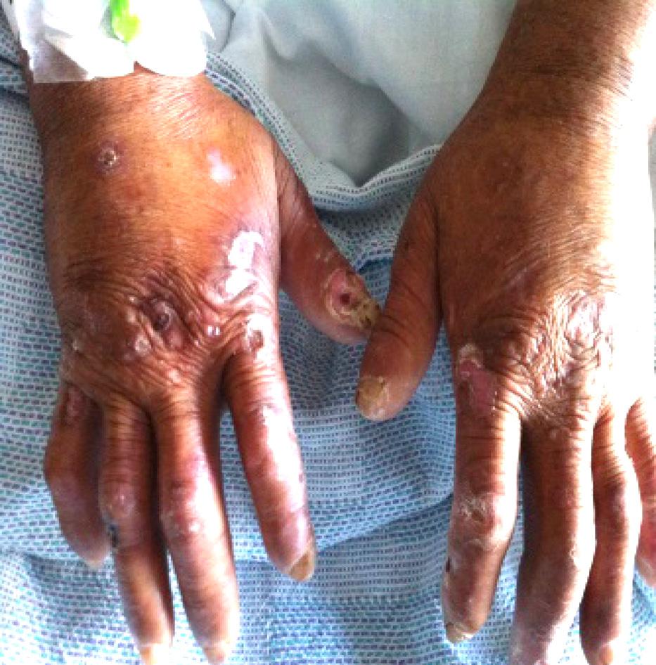 Quansah R. et al: A C B D Figure 1. (A C) Blistering, hypo/hyper pigmented lesions over the dorsal aspects of the hands and other sun-exposed areas.