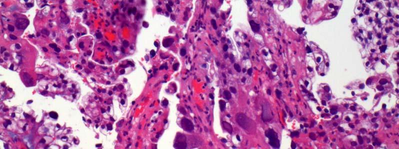 Tumors Arising in Endometriosis Endometriosis is risk factor for ovarian cancer
