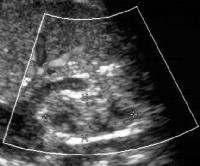 Slika 5.: Ultrazvučni prikaz hipoplastičnog i hiperehogenog bubrega, preuzeto s http://emedicine.medscape.com/article/983074-workup#a072 