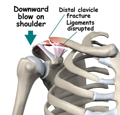 Near the AC joint there are two ligaments that connect the distal clavicle to the coracoid (another part of the scapula), the coracoclavicular ligaments.