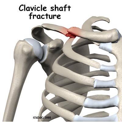 This can usually be accomplished with a careful physical examination. Treatment Most clavicle fractures are treated without surgery.
