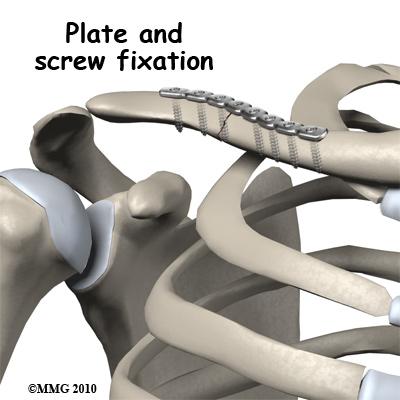 Surgical treatment of clavicle fractures is usually performed two ways: a long metal screw inside the bone or a metal plate and screws along the side of the bone.