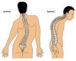 spine Scoliosis